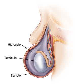 Vista lateral del escroto, donde puede verse un hidrocele alrededor del testículo.