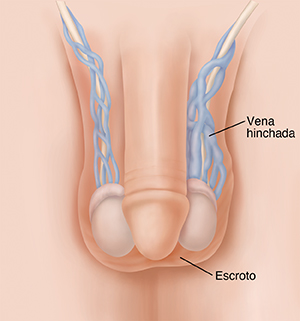 Vista frontal del pene y los testículos que muestra la presencia de varicocele.