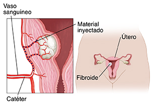 Primer plano de un fibroma en la pared de un útero. Se inserta un catéter en un vaso sanguíneo del útero para inyectar un material dentro de los vasos pequeños que están cerca del fibroide.