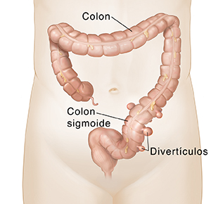 Vista frontal del colon con divertículos en la parte inferior.