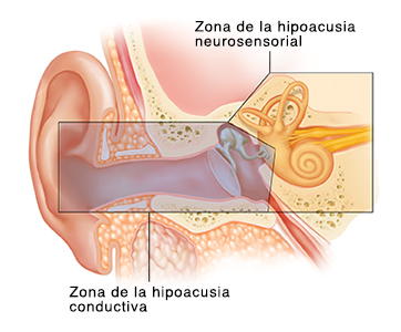 Corte transversal del oído donde pueden verse las estructuras del oído externo, interno y medio. La superposición de colores muestra áreas que causan pérdida de audición conductiva y neurosensorial.