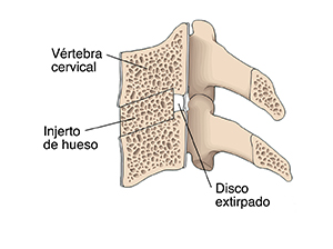 Vista lateral de un corte transversal de dos vértebras cervicales donde puede verse el disco que se extrajo y el injerto óseo que se fusiona con las vértebras.