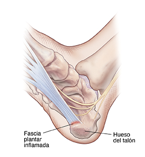 Vista inferior de un pie donde se observa la fascia plantar inflamada.