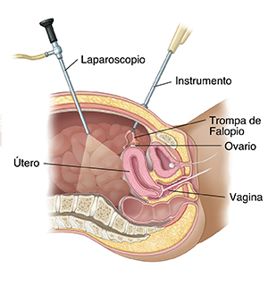 Corte transversal de una pelvis de mujer vista de lado donde se ve la laparoscopia.