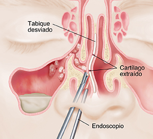 Primer plano de los instrumentos que se insertan en la nariz para reparar el tabique desviado. Los senos paranasales tienen pólipos.