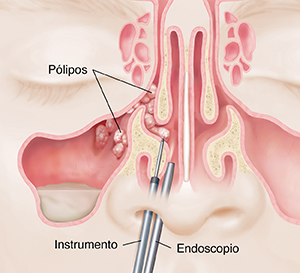 Primer plano de los instrumentos que se insertan en la nariz para extirpar los pólipos.