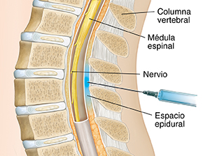 Corte transversal de la parte inferior de una columna vertebral con una aguja introducida justo por fuera del saco alrededor de la médula espinal.