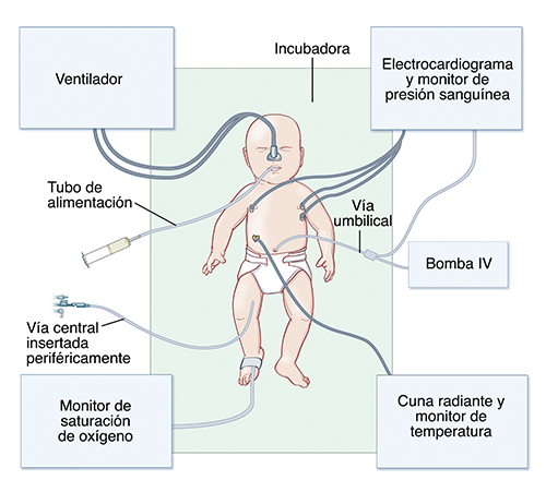 Vista superior de un bebé en una incubadora donde puede verse un equipo de la unidad de cuidados intensivos neonatales.