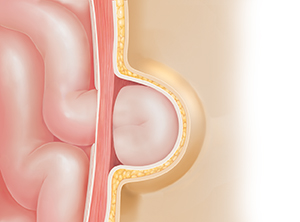 Corte transversal de una pared corporal donde puede verse una hernia. El intestino sobresale por el defecto en el músculo debajo de la piel.
