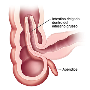 Corte transversal del intestino que muestra una intususcepción.