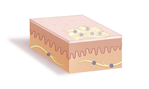 Corte de la piel donde se observa una llaga con costra en la superficie y con el virus del herpes en su interior.