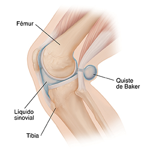 Vista lateral de una rodilla flexionada donde se observa el quiste de Baker.