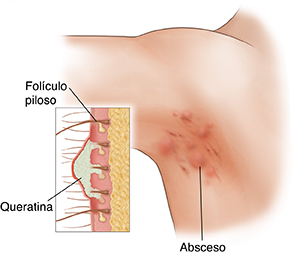 View of armpit showing red bumps and inflammation. An inset shows buildup in the hair follicles. 