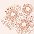 Ilustración que muestra células anormales todavía reunidas en forma de anillo en el cáncer de próstata de grado 1 o 2.