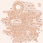 Ilustración que muestra células anormales que varían en tamaño y en forma con menos células reunidas en forma anular en el cáncer de próstata de grado 3.