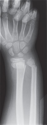 Radiografía de una mano y un brazo que muestra una fractura de muñeca.