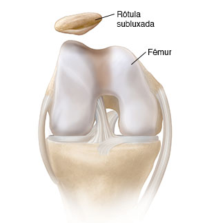 Vista frontal de una rodilla doblada en donde se ve la rótula dislocada.