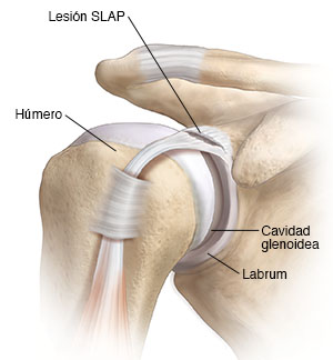 Vista frontal de la articulación del hombro en donde se ve una lesión SLAP.