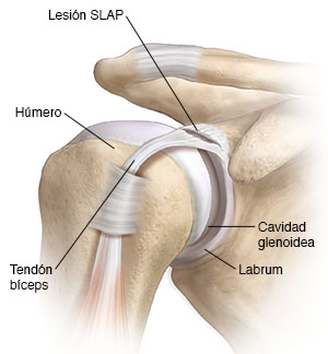 Vista frontal de la articulación del hombro en donde se ve una lesión SLAP.