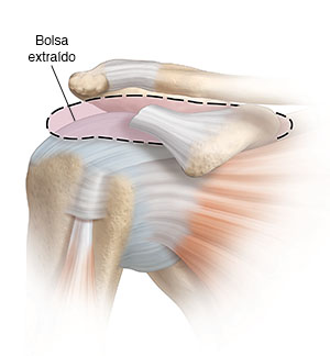 Vista frontal de la articulación del hombro donde se observa la extirpación de la bolsa sinovial inflamada.