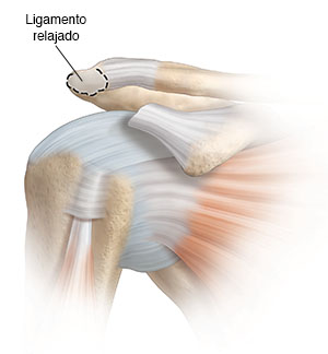 Vista frontal de la articulación del hombro donde se puede ver el tendón liberado y el hueso que se quitará.