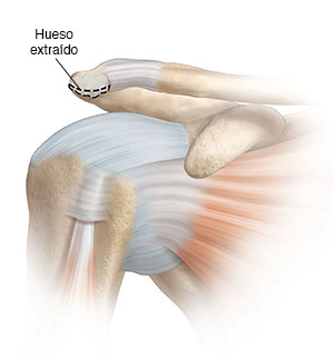 Vista frontal de la articulación del hombro donde se puede ver el tendón liberado y el hueso que se quitará.