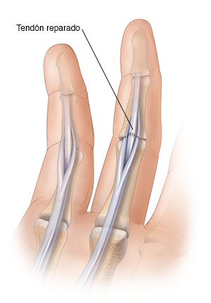 Vista de la palma de una mano donde se observan suturas que reparan un tendón flexor cortado. 