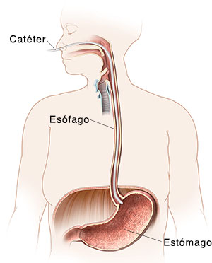 Contorno de una mujer donde pueden verse la boca, el esófago y el estómago. Catéter de manometría esofágica insertado a través de la nariz hasta el estómago.