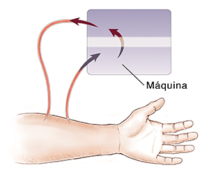 Primer plano de un brazo donde pueden verse una fístula entre la arteria y la vena y los catéteres que transportan sangre hacia/desde el dializador para hemodiálisis.
