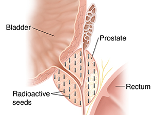 Corte transversal de una próstata donde se ven las semillas radiactivas usadas en la braquirradioterapia intersticial.