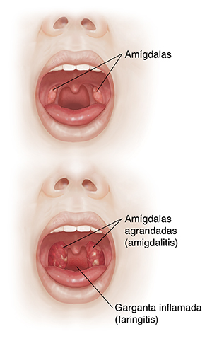 Vista frontal de una cara con la boca abierta donde se compara una cavidad oral y amígdalas normales con una garganta inflamada y amígdalas agrandadas.