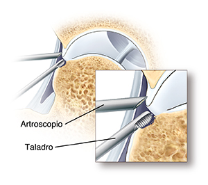Primer plano de la punta de un artroscopio en la articulación de la cadera y un trépano que desgasta el hueso excedente.