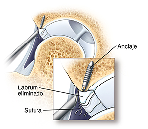 Corte transversal de una articulación de cadera en donde se ve la punta de un artroscopio cerca de un anclaje en el hueso, debajo del labrum. Primer plano de la punta de un artroscopio cerca de un anclaje en el hueso, debajo del labrum. Las suturas unidas al anclaje y atadas alrededor del labrum unen los bordes rotos.