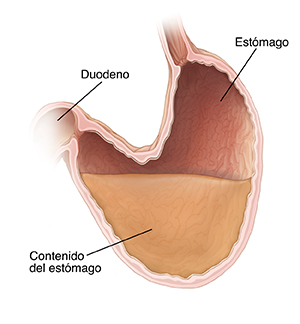 Corte transversal de estómago y duodeno. El estómago está agrandado y tiene una parte caída. El contenido del estómago que queda en esa parte floja no puede moverse adecuadamente para salir del estómago y entrar en el duodeno.