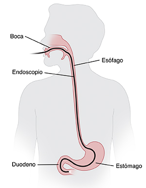 Contorno de un niño con la cabeza girada de lado para mostrar un endoscopio insertado en la boca, esófago, estómago y que termina en el duodeno.