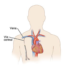 Parte superior del torso de una persona en donde se muestran el corazón y los grandes vasos sanguíneos que entran y salen del mismo. Se ilustra también un catéter entrando en una vena cercana a la clavícula.