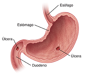 Corte transversal del estómago que muestra úlceras en el estómago y el duodeno.