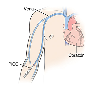 Vista frontal de un hombre donde pueden verse el corazón y las venas con un catéter insertado en el antebrazo (línea PICC).