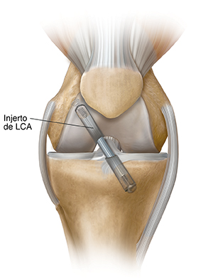 Vista frontal de rodilla en donde se ve un injerto que repara el ligamento cruzado anterior.