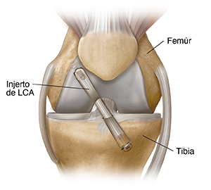 Vista frontal de la articulación de la rodilla donde puede verse el injerto en el LCA.