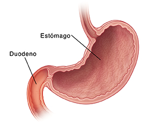 Corte transversal de estómago y duodeno. El duodeno está inflamado.