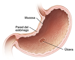 Corte transversal del estómago donde puede verse una úlcera.