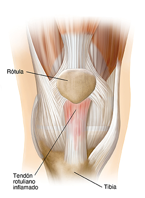 Vista frontal de articulación de rodilla que muestra la rótula, la tibia (espinilla) y el tendón rotuliano inflamado.