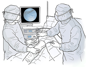 Dos proveedores de atención médica haciendo una artroscopia de rodilla a un paciente en el quirófano.