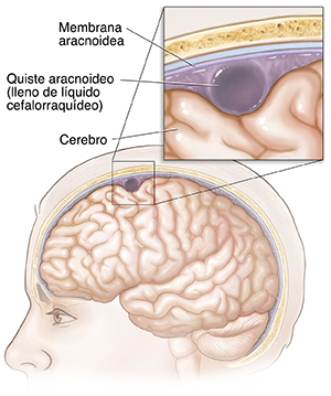 Vista lateral de la cabeza y el cerebro con un primer plano de un quiste aracnoideo.