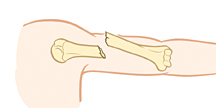 Parte superior del brazo donde se observa una fractura abierta.