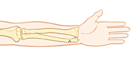Huesos de la parte superior del brazo donde se observa una fractura en tallo verde de la muñeca.