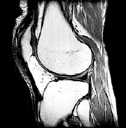 Imagen de resonancia magnética de la rodilla.