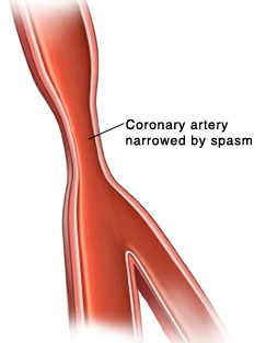 Cross section of artery with narrowing due to spasm.