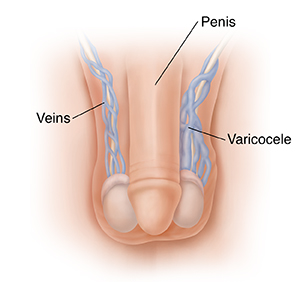 Front view of male genitals showing penis, veins, and varicocele.